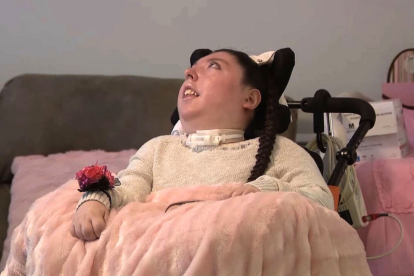 Alex Simpson nació sin cerebro y llega a los 20 años de vida.