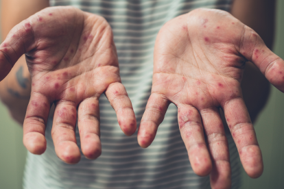 Sarampión activa alerta en Perú.