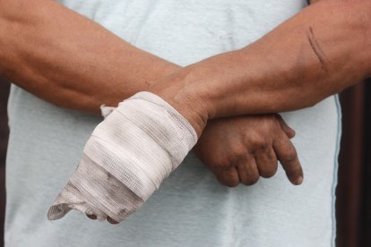 Las lesiones que sufrió en su mano derecha a causa de las quemaduras.
