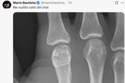 El cantante compartió una radiografía que evidenció una fractura