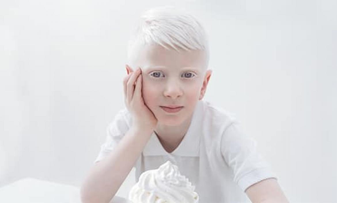 Imagen Albino 1