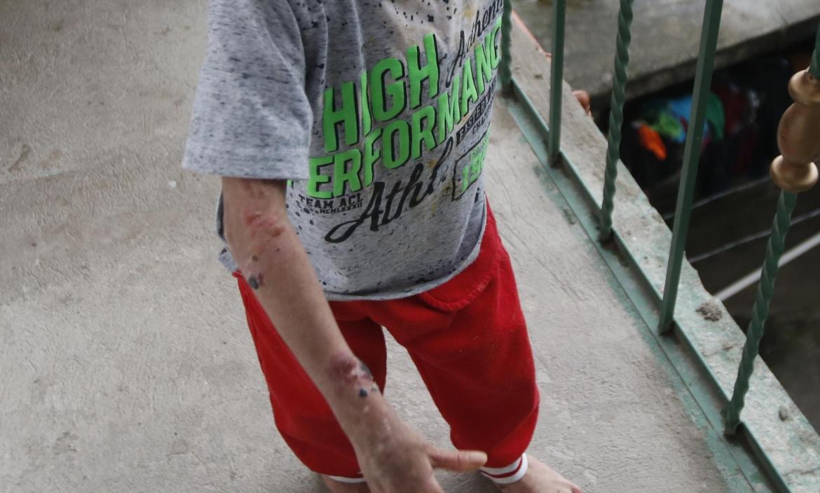 NIÑO CON ENFERMEDAD DE LA PIEL