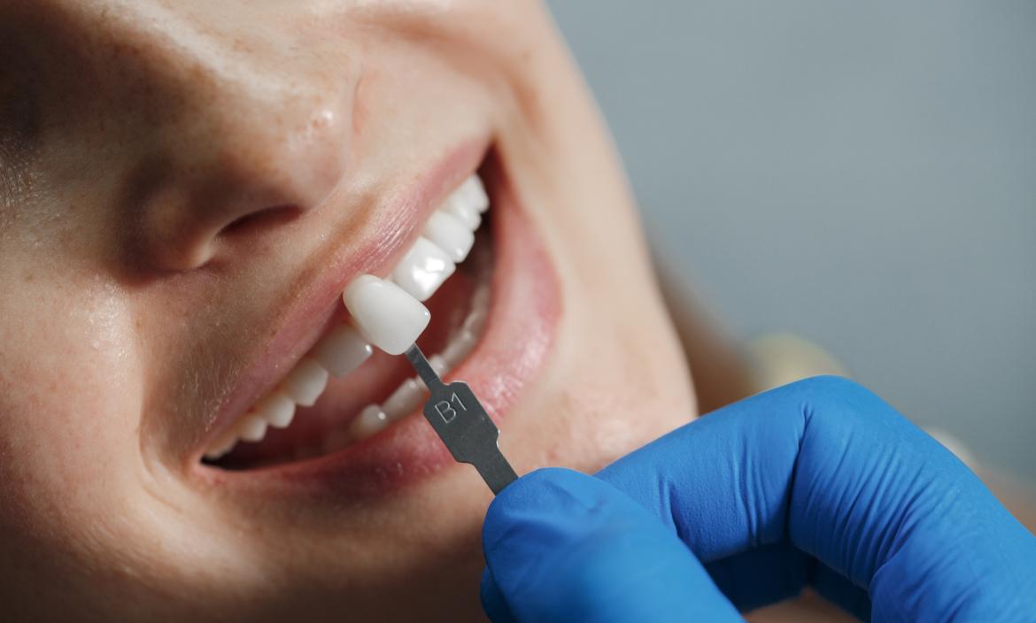 dentista-blanqueando-dientes