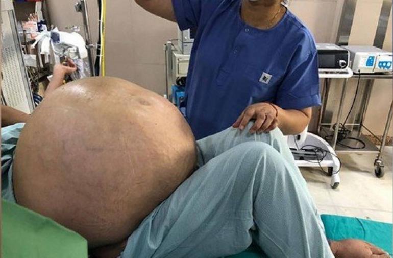 tumor-gigante-ovario-india-kilos