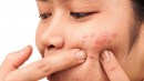 Logran reducir las cepas de las bacterias de la piel que causan el acné