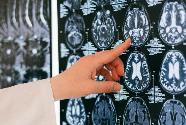 Imagen referencial. El paciente en cuestión tuvo un aneurisma cerebral.