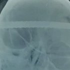  La operación para retirar el objeto duró una hora y media.  