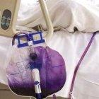  Diez días después de hospitalización tras un derrame cerebral, la orina de una mujer apareció color morado. Los médicos investigaron la razón.  
