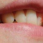  La bacteria que produce la gingivitis genera una bacteria capaz de destruir las células nerviosas del cerebro. 