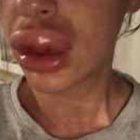  Knappier había acudido a una “fiesta de botox”, pero sin intención de inyectarse el líquido en su cuerpo.  