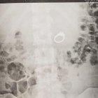  Los médicos tuvieron que realizarle una endoscopía para extraer la sortija. 
