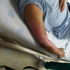  Las quemaduras lesionan la piel. En algunas ocasiones las heridas son más graves.  