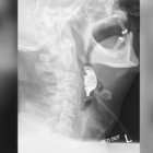  A través del examen de Rayos X los médicos lograron encontrar la dentadura del hombre. 