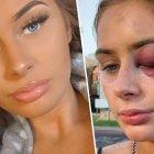  La adolescente Gabrielle Walsh antes y después de recibir el golpe en la cara. 