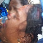  Carolina fue llevada hasta el hospital de Monte Sinaí donde recibió la atención médica. Tenía un corte en el lado izquierdo de su cabeza, en el rostro y en uno de sus brazos.  