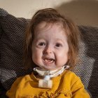  El tipo de displasia mandibuloacral que padece Isla es único en el mundo. 