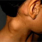  Referencial. El linfoma es la inflamación de uno o más ganglios linfáticos que puede estar en el cuello. 