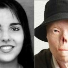  La joven, sufrió quemaduras de tercer grado en más del 60% de su cuerpo tras un accidente automovilístico en 1999. 