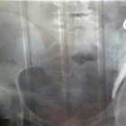  La radióloga llegó a pensar que se trataba de unas tijeras en el bolsillo de la mujer. 