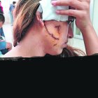  Una cicatriz de casi 12 centímetros cubre la mejilla derecha de la chica de 20 años.  