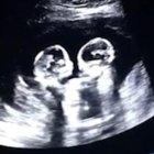  El audiovisual muestra el momento exacto en que una de las gemelas golpea a su hermana con el brazo.  