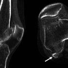  Las flechas indican la posición de fabela en las articulaciones actuales. 