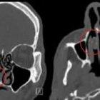  Se puso la droga en la nariz para pasar los controles de seguridad en la cárcel. Lo logró, pero nunca más la logró sacar.  