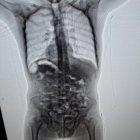  Se detectó que llevaba en su organismo 13.893 dosis de cocaína. Una placa radiográfica así lo confirmó 