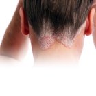  Las partes que generalmente se ven perjudicadas por este mal son los costados de la nariz, la parte que existe entre las cejas y en la frente.   