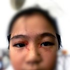  Fue diagnosticada con hematidrosis, también sufre fuertes dolores de cabeza 