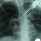  Aún con la navaja incrustada en su espalda, la víctima logró sobrevivir y ahora se encuentra internada en el hospital.  