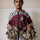  Abul Bajandar, diagnosticado con epidermodisplasia verruciforme 