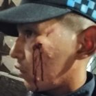  Los golpes que recibieron los cuatro agentes les dejó heridas en los ojos y en las mejillas. Uno de ellos sería operado. 