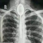  Vivió más de un año con el objeto metálico dentro de su cuerpo. 