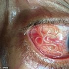  El hombre también tenía gusanos en su sangre. 