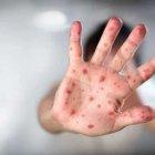  El sarampión es una enfermedad viral altamente contagiosa y que puede resultar mortal. 