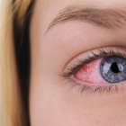  Referencial. El brote de conjuntivitis en Guayaquil, llegó después del feriado de Carnaval. 