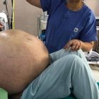 Imagen del tumor de 50 kilos antes de ser extirpado.