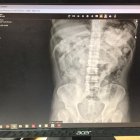 Los sospechosos fueron internados en un hospital de Quito hasta que expulsaran las cápsulas de droga.