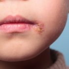 Se trata de una infección común en los niños.