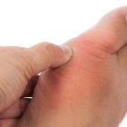 Los alimentos con purina incrementan las crisis de gota.