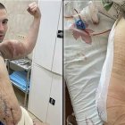 Los efectos secundarios obligaron al hombre a quitarse el producto de sus extremidades.