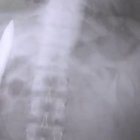 La radiografía muestra la hoja de cuchillo alojada en el torso de la víctima de un ataque.