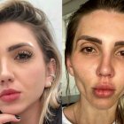 La influencer dio a conocer su experiencia para quienes quieran hacerse la misma operación.