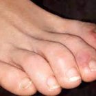 Algunos pacientes con Covid desarrollan un daño en los dedos de sus pies.