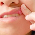 Las aftas pueden ser dolorosas. Evite cítricos y picantes.