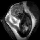 Imágenes de una resonancia magnética en el desarrollo del cerebro fetal.