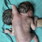 ¡Nació un bebé con dos cabezas, dos corazones y tres brazos!