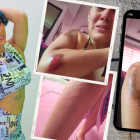 Zully sufrió varias lesiones en su cuerpo tras la caída.