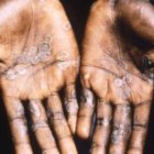 Daños que provoca la enfermedad que está asustando al mundo.